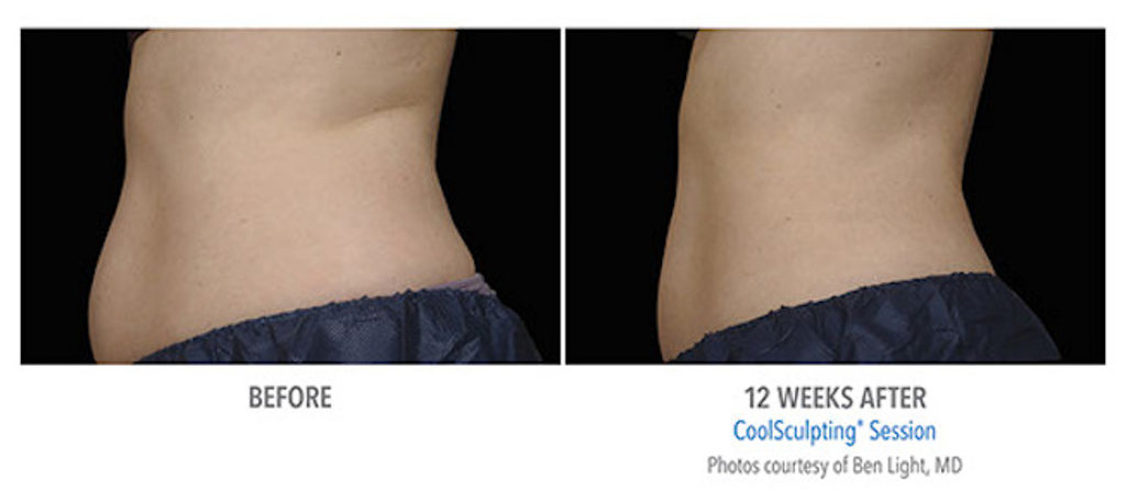 Penn Highlands Plastic Surgery CoolSculpting Before and After image