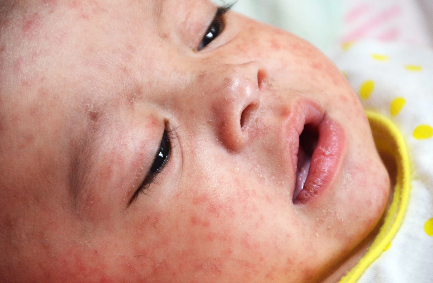 Preventing the measles penn highlands healthcare