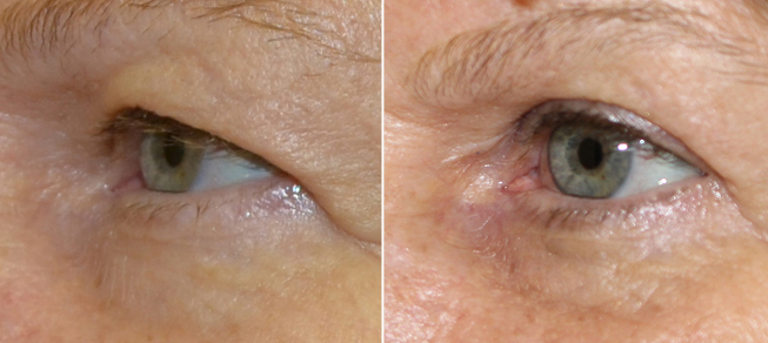 Eyelid Surgery (Blepharoplasty) 