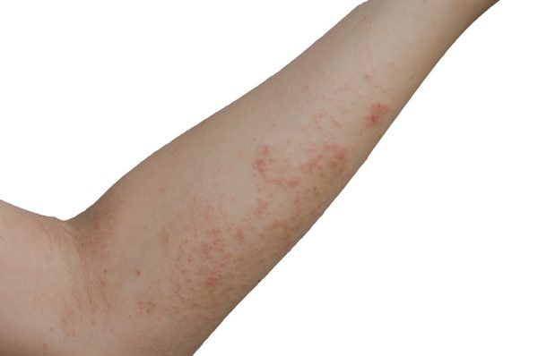 Scabies Requires Prescribed Care Penn Highlands Healthcare